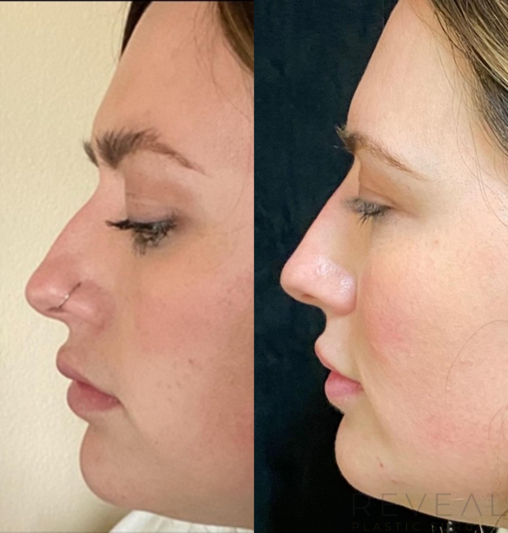 Before & After Injectable Fillers Case 532 View #1 View in San Jose, CA