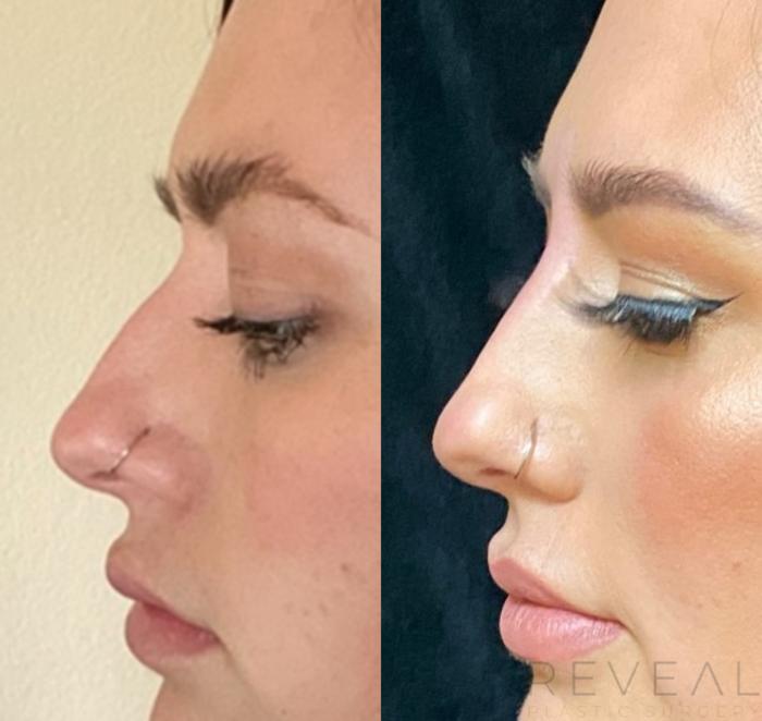 Before & After Injectable Fillers Case 532 View #2 View in San Jose, CA