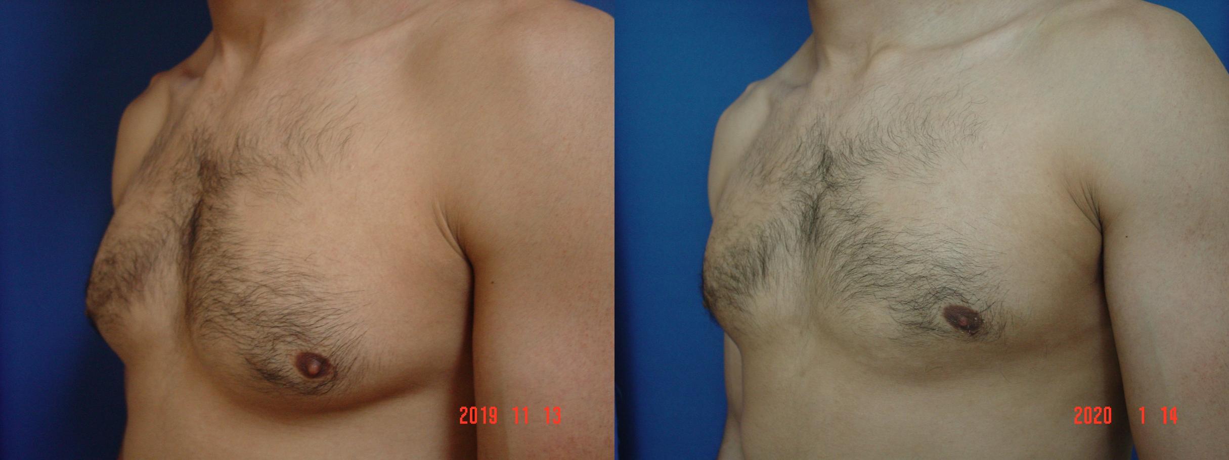 Before & After Male Breast Reduction Case 386 View #1 View in San Jose, CA