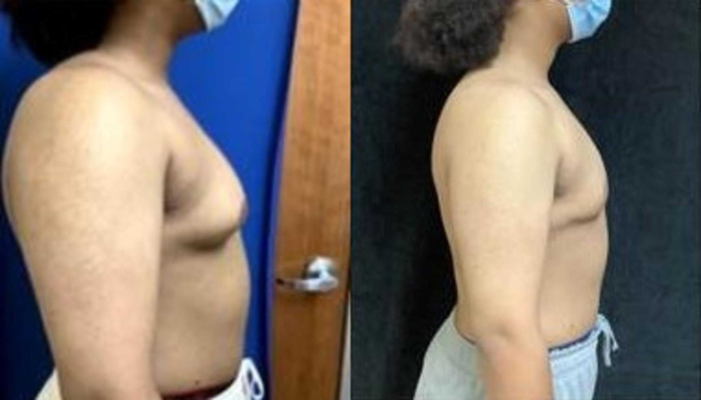 Before & After Male Breast Reduction Case 471 View #1 View in San Jose, CA