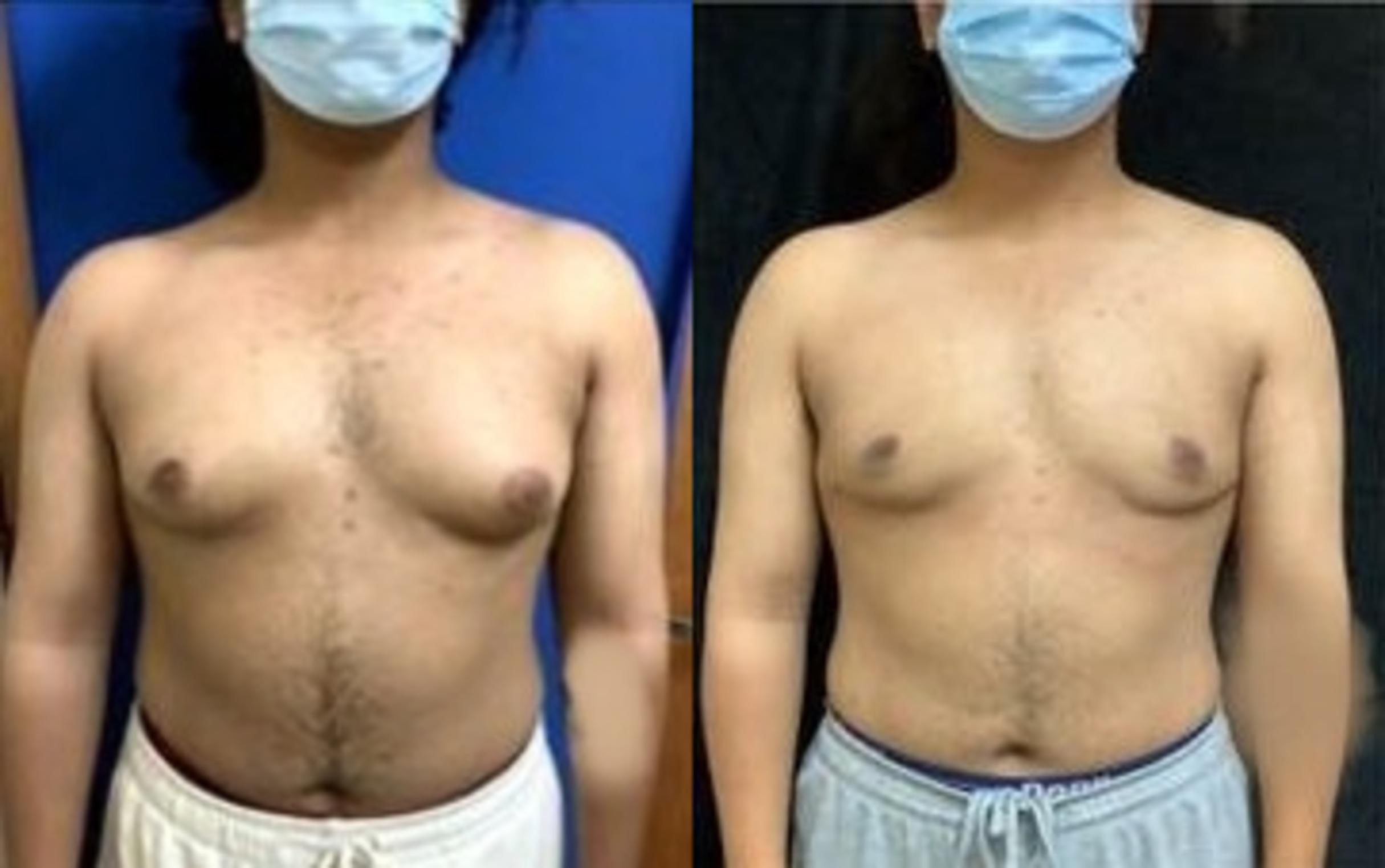 Before & After Male Breast Reduction Case 471 View #2 View in San Jose, CA