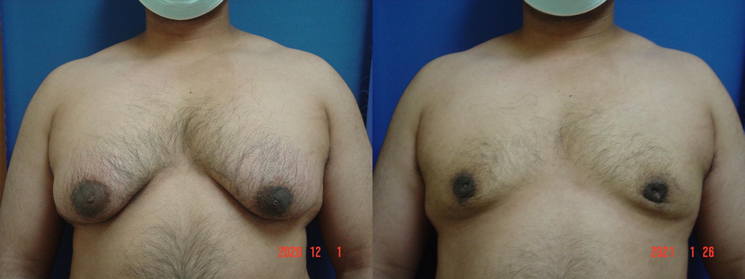 Before & After Male Breast Reduction Case 526 View #1 View in San Jose, CA