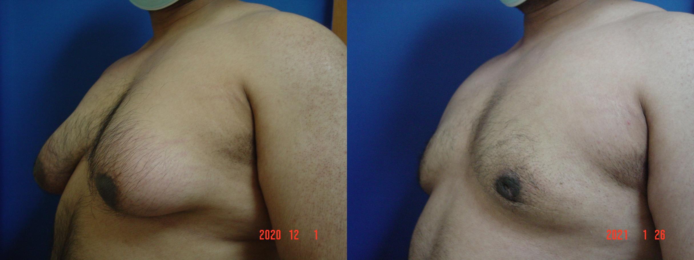 Before & After Male Breast Reduction Case 526 View #2 View in San Jose, CA