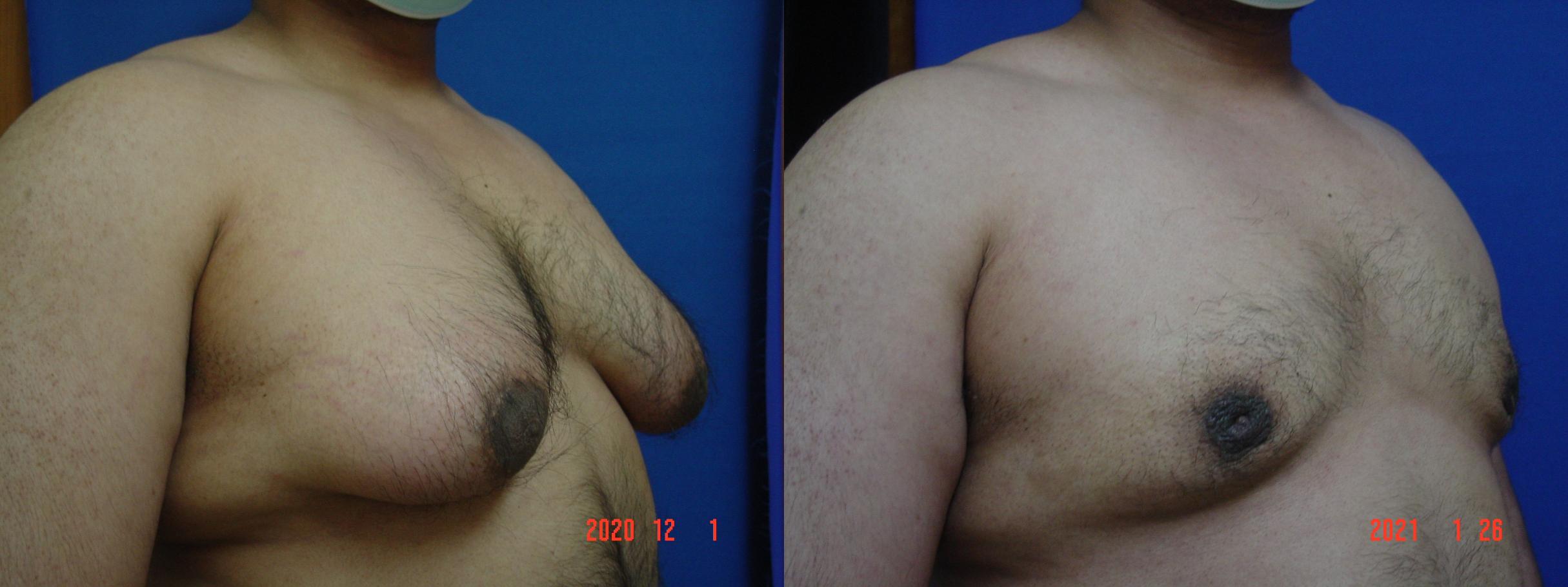 Before & After Male Breast Reduction Case 526 View #3 View in San Jose, CA