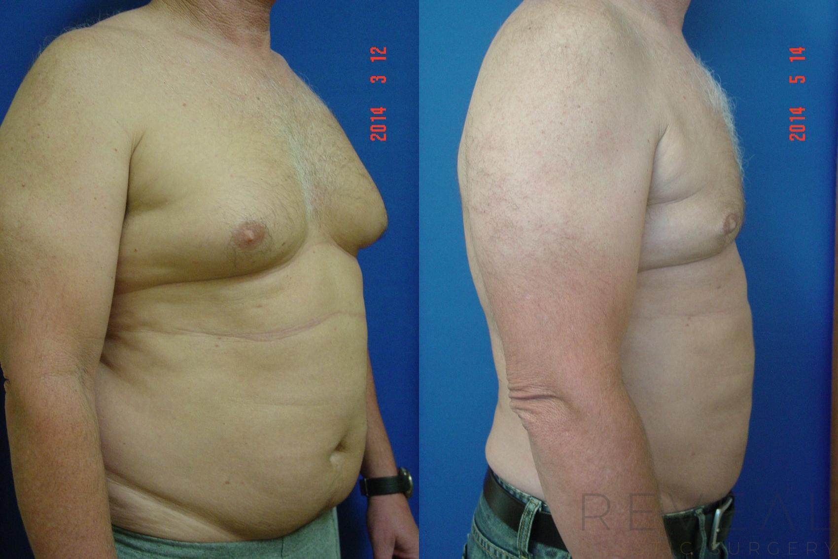 Before & After Male Breast Reduction  Gynecomastia  Case 137 View #1 View in San Jose, CA