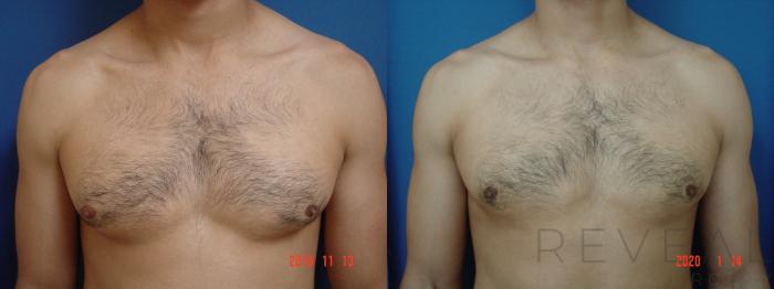 Before & After Male Breast Reduction  Gynecomastia  Case 386 View #2 View in San Jose, CA