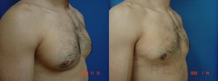 Before & After Male Breast Reduction  Gynecomastia  Case 386 View #3 View in San Jose, CA