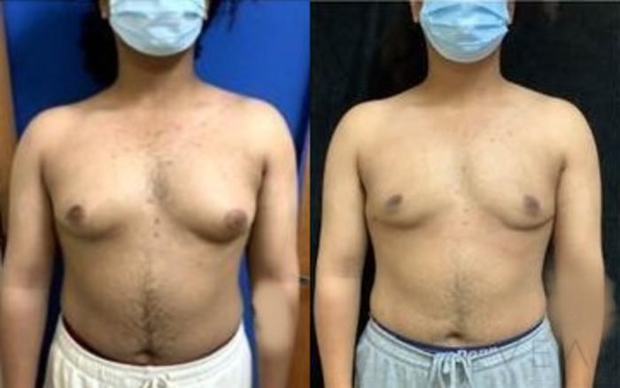 Before & After Male Breast Reduction  Gynecomastia  Case 471 View #2 View in San Jose, CA