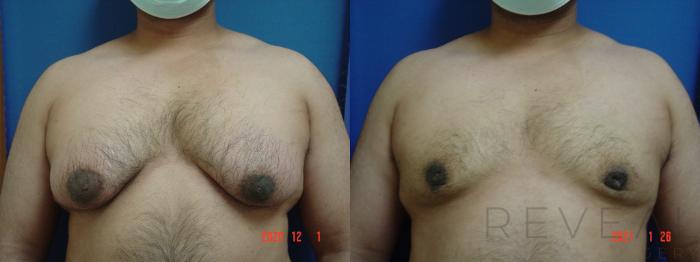 Before & After Male Breast Reduction  Gynecomastia  Case 526 View #1 View in San Jose, CA