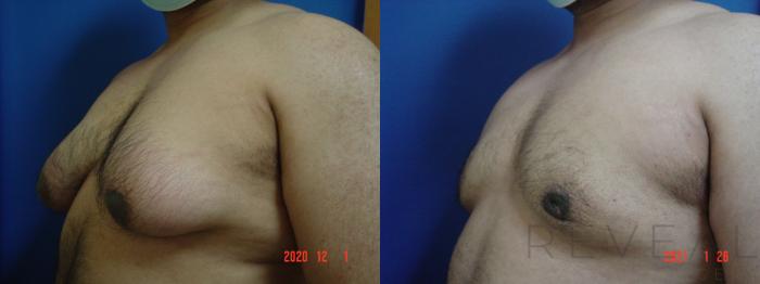 Before & After Male Breast Reduction  Gynecomastia  Case 526 View #2 View in San Jose, CA
