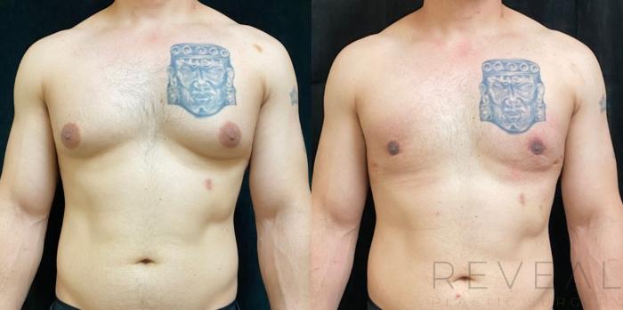 Before & After Male Breast Reduction  Gynecomastia  Case 534 View #1 View in San Jose, CA