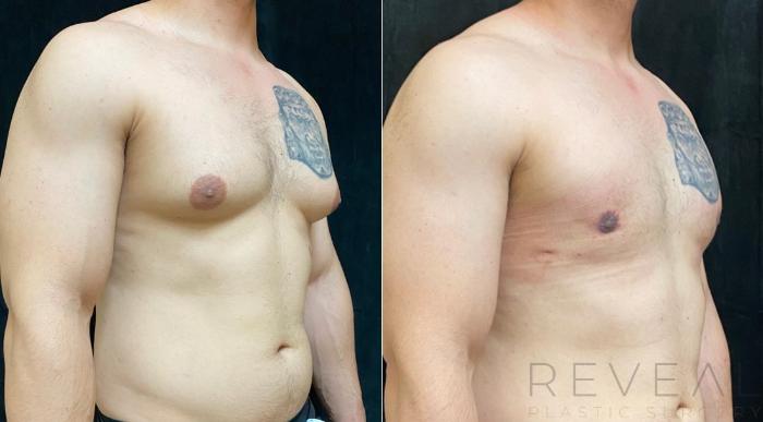 Before & After Male Breast Reduction  Gynecomastia  Case 534 View #2 View in San Jose, CA