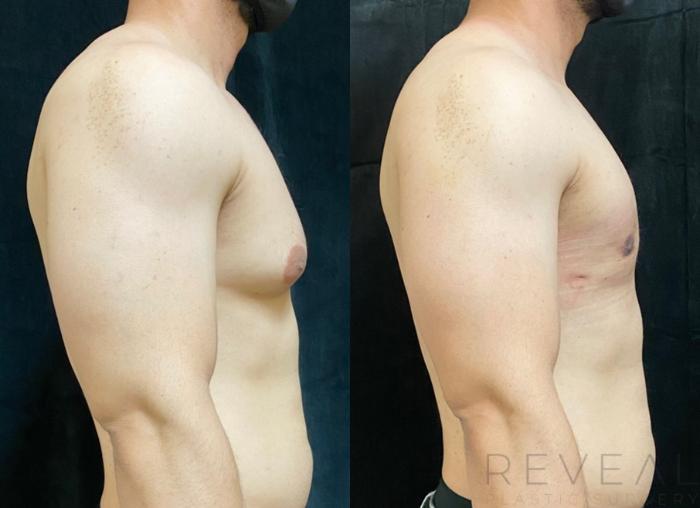 Before & After Male Breast Reduction  Gynecomastia  Case 534 View #3 View in San Jose, CA