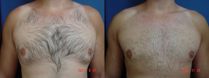 Before & After Male Breast Reduction  Gynecomastia  Case 595 Front View in San Jose, CA