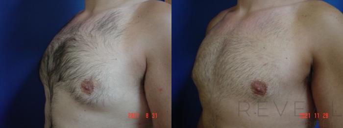 Before & After Male Breast Reduction  Gynecomastia  Case 595 Left Oblique View in San Jose, CA