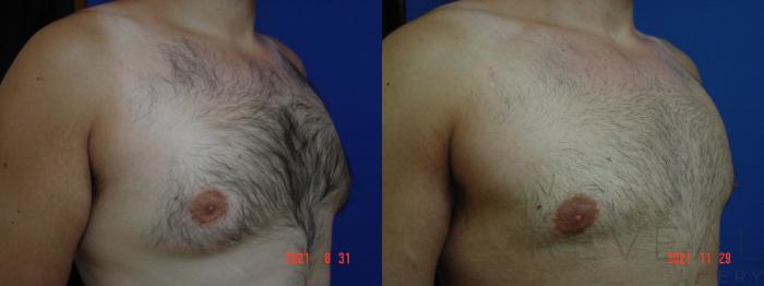 Before & After Male Breast Reduction  Gynecomastia  Case 595 Right Oblique View in San Jose, CA