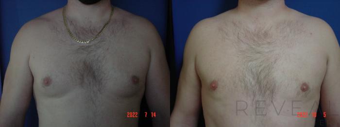 Before & After Male Breast Reduction  Gynecomastia  Case 669 Front View in San Jose, CA