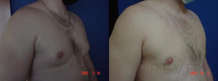 Before & After Male Breast Reduction  Gynecomastia  Case 669 Left Side View in San Jose, CA