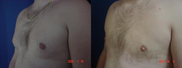 Before & After Male Breast Reduction  Gynecomastia  Case 669 Right Side View in San Jose, CA