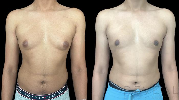 Before & After Male Breast Reduction  Gynecomastia  Case 769 Front View in San Jose, CA