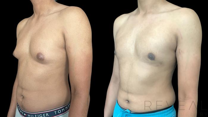 Before & After Male Breast Reduction  Gynecomastia  Case 769 Left Oblique View in San Jose, CA
