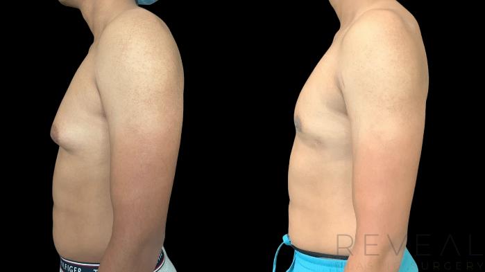 Before & After Male Breast Reduction  Gynecomastia  Case 769 Left Side View in San Jose, CA
