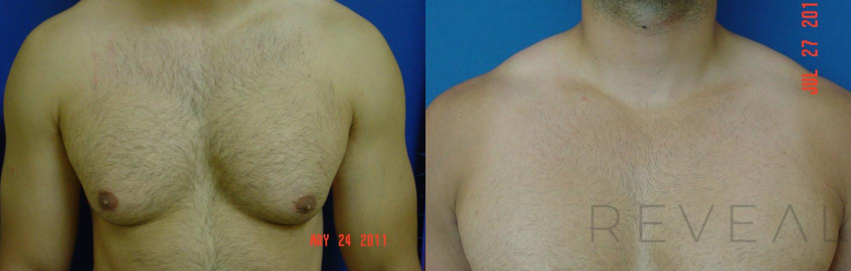 Before & After Male Breast Reduction  Gynecomastia  Case 78 View #1 View in San Jose, CA