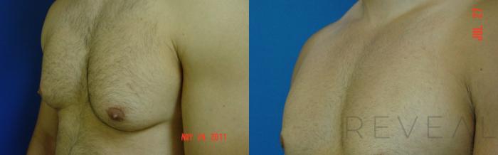 Before & After Male Breast Reduction  Gynecomastia  Case 78 View #2 View in San Jose, CA