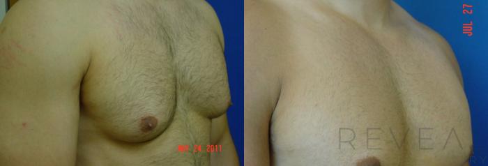 Before & After Male Breast Reduction  Gynecomastia  Case 78 View #3 View in San Jose, CA