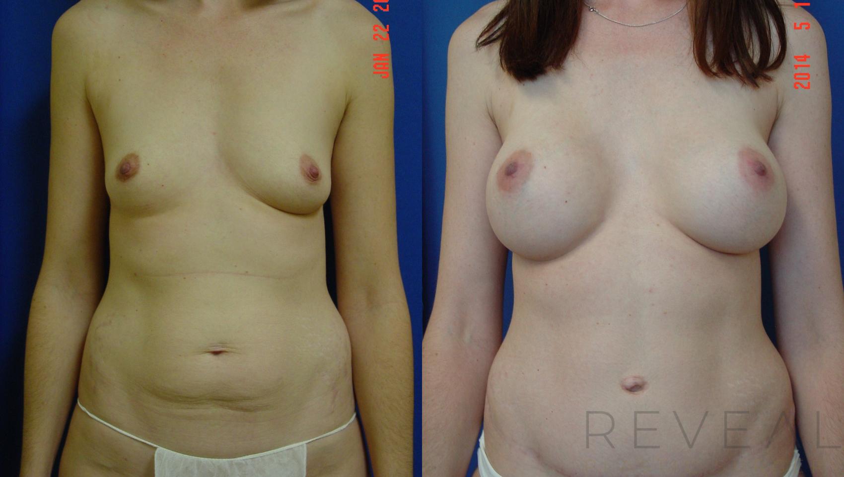 Before & After Tummy Tuck Case 140 View #1 View in San Jose, CA