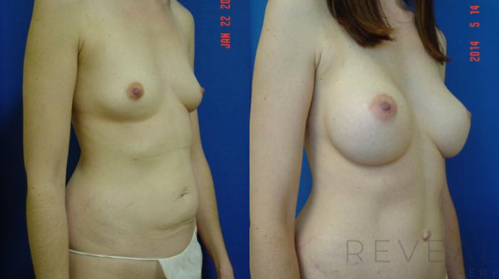 Before & After Breast Augmentation Case 140 View #2 View in San Jose, CA