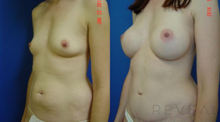 Before & After Tummy Tuck Case 140 View #3 View in San Jose, CA