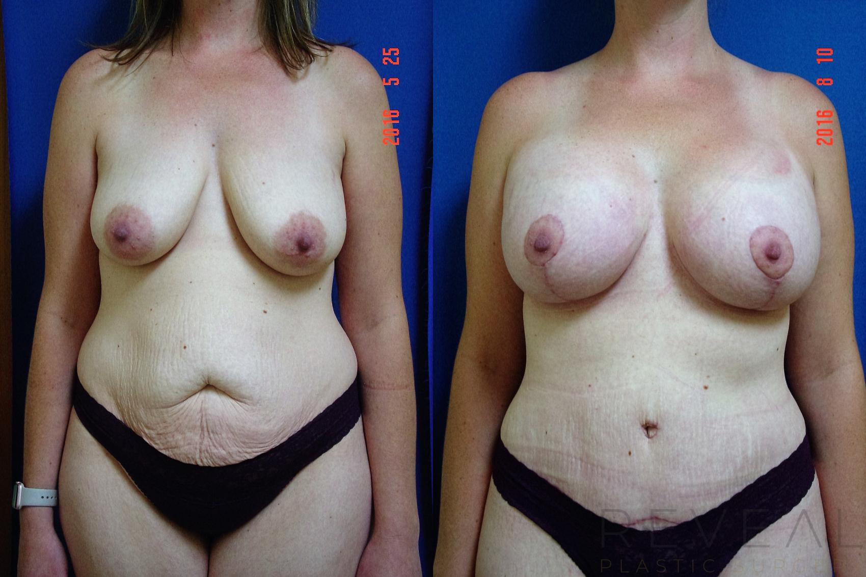 Before & After Tummy Tuck Case 195 View #1 View in San Jose, CA