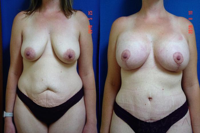 Before & After Breast Lift Case 195 View #1 View in San Jose, CA
