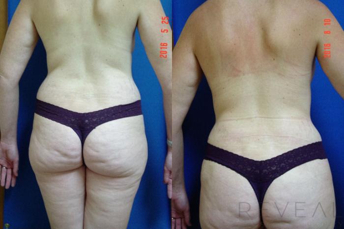 Before & After Tummy Tuck Case 195 View #3 View in San Jose, CA