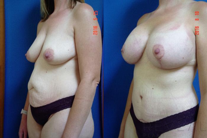 Before & After Breast Lift Case 195 View #4 View in San Jose, CA