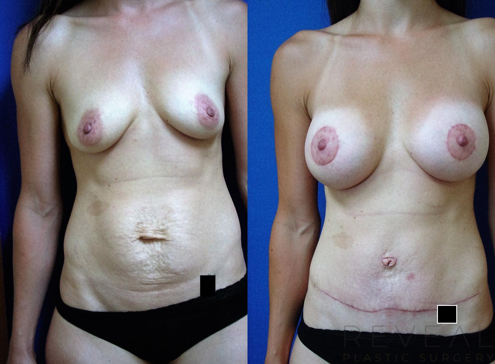 Before & After Breast Augmentation Case 196 View #1 View in San Jose, CA
