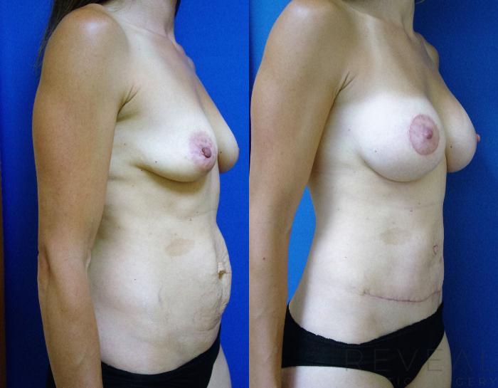 Before & After Liposuction Case 197 View #1 View in San Jose, CA