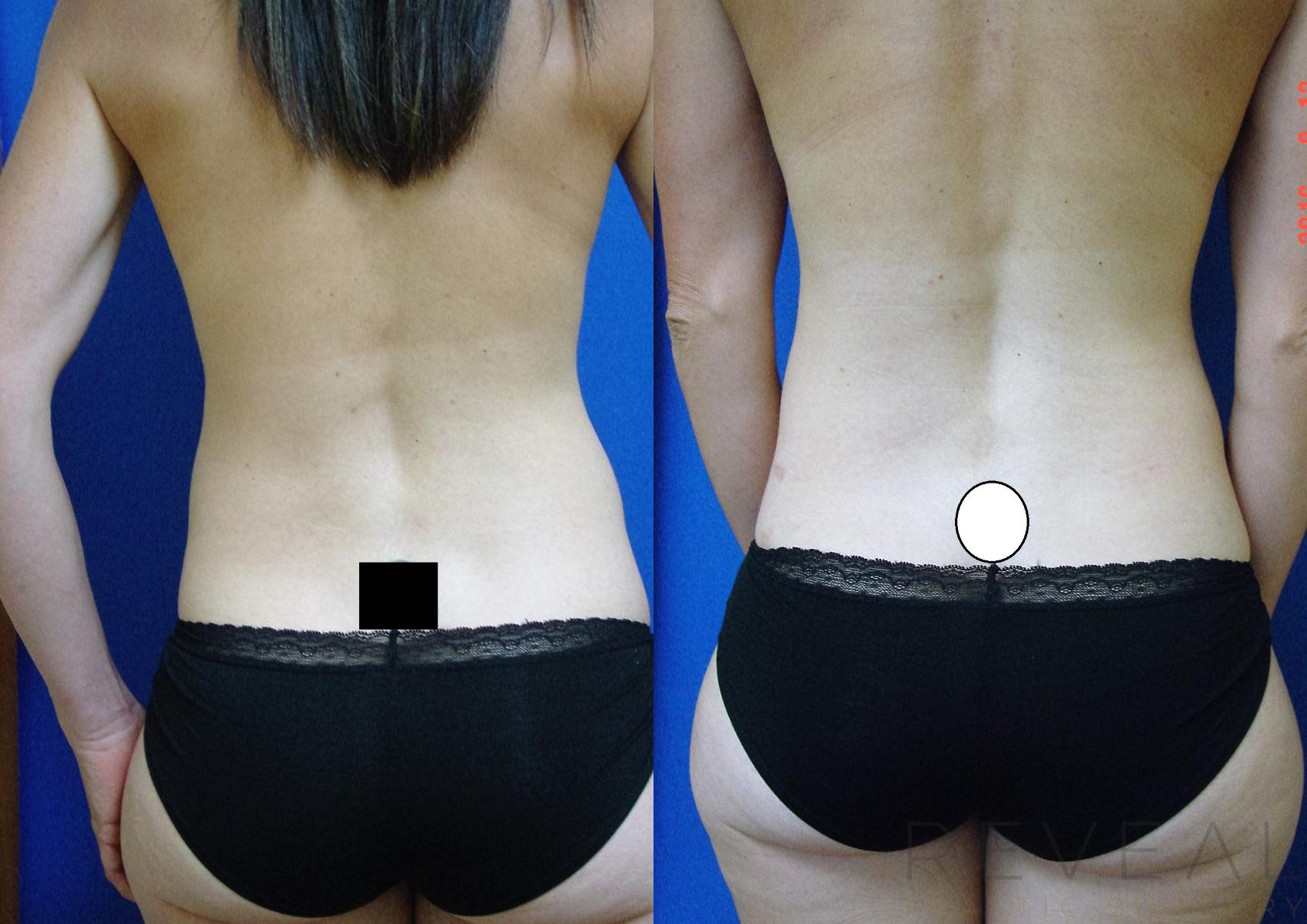 Before & After Breast Lift Case 197 View #3 View in San Jose, CA