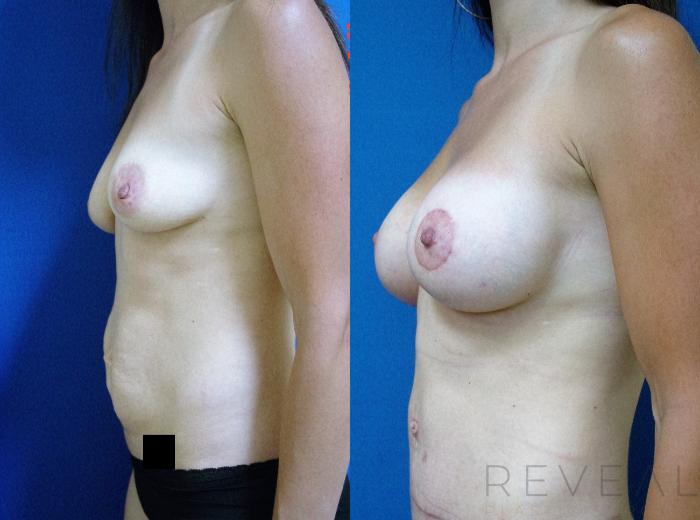 Before & After Tummy Tuck Case 197 View #4 View in San Jose, CA