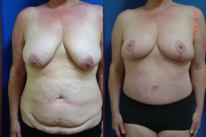 Before & After Liposuction Case 199 View #1 View in San Jose, CA