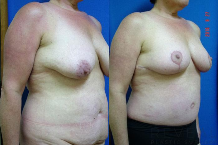 Before & After Liposuction Case 199 View #3 View in San Jose, CA