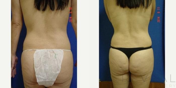 Before & After Tummy Tuck Case 200 View #2 View in San Jose, CA