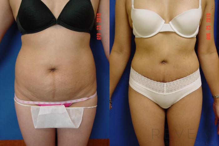 Before & After Liposuction Case 22 View #1 View in San Jose, CA