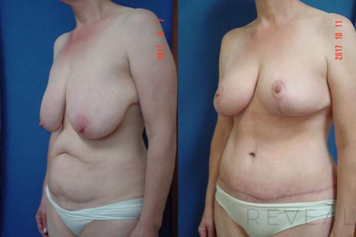 Before & After Breast Lift Case 232 View #2 View in San Jose, CA