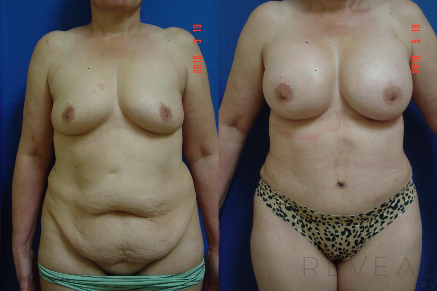 Before & After Liposuction Case 245 View #1 View in San Jose, CA