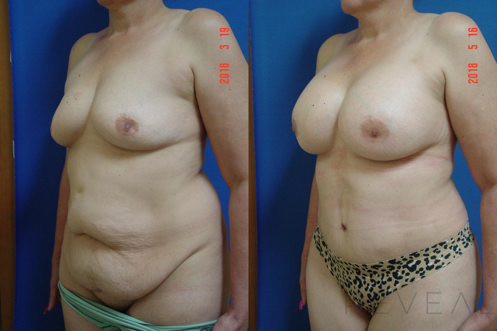 Before & After Liposuction Case 245 View #2 View in San Jose, CA