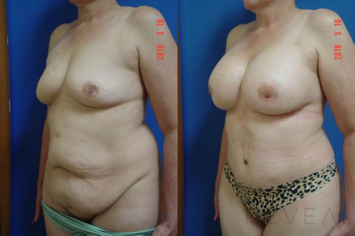 Before & After Breast Augmentation Case 245 View #2 View in San Jose, CA