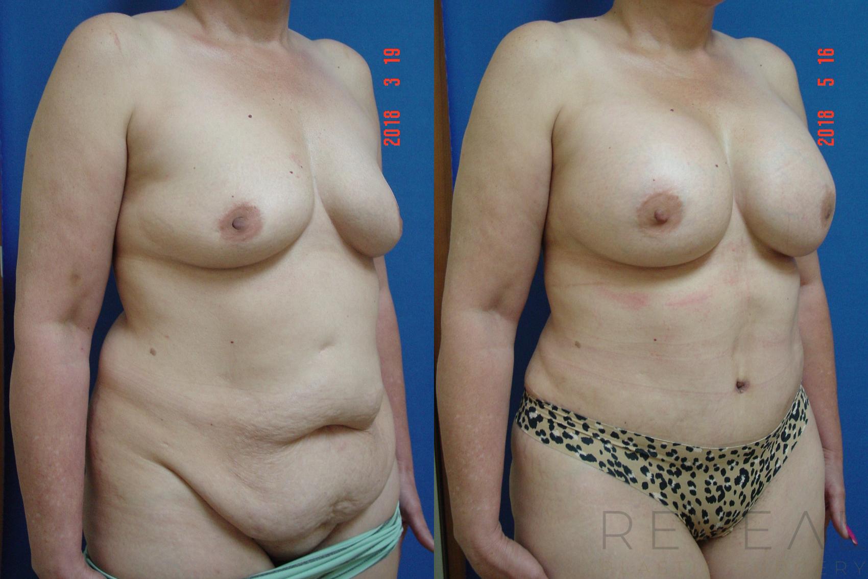 Before & After Liposuction Case 245 View #3 View in San Jose, CA