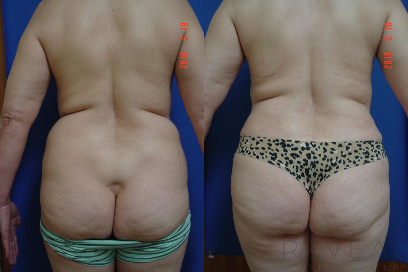 Before & After Liposuction Case 245 View #4 View in San Jose, CA